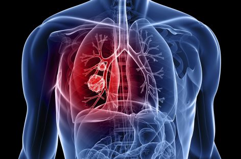O metodă de tratament pentru hipertensiune arterială pulmonară, dezvoltată de cercetători americani