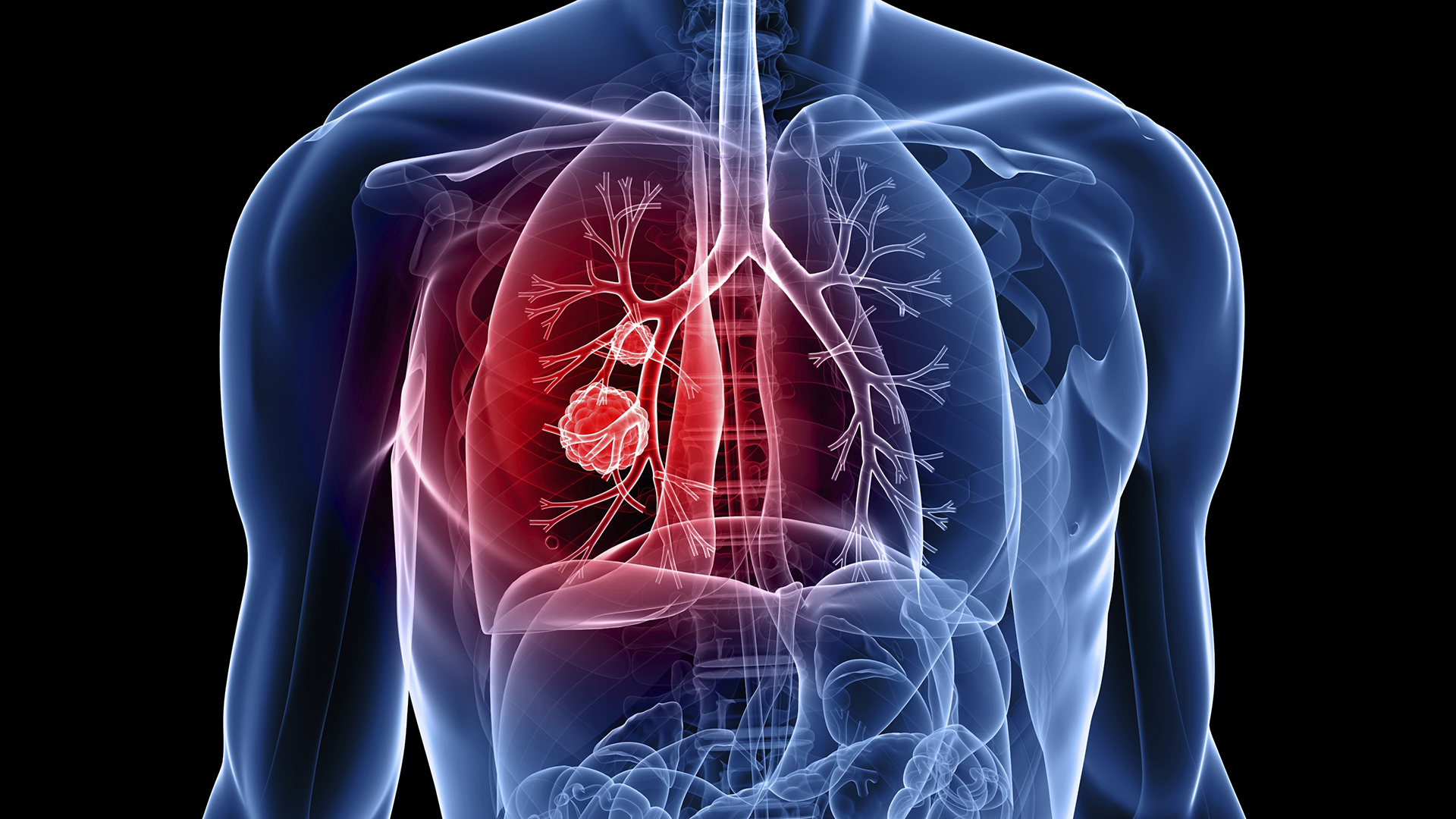 O metodă de tratament pentru hipertensiune arterială pulmonară, dezvoltată de cercetători americani