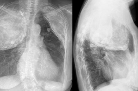 O nouă metodă de tratare a tuberculozei rezistente la medicamente prin îmbunătăţirea apărărilor imunitare ale pacienţilor