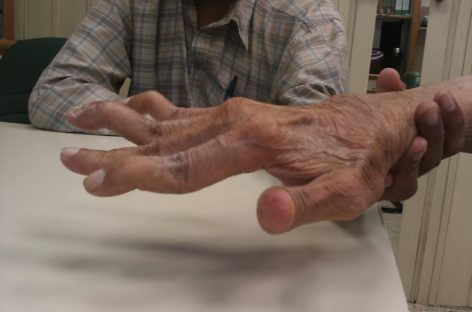 Poliartrita reumatoidă creşte riscul de depresie, obezitate şi boli cardiovasculare