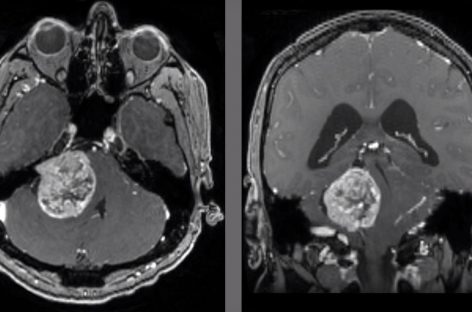 Studiu: Celulele imune lasă amprente în tumorile care metastazează în creier, oferind indicii pentru noi terapii