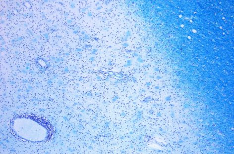 Bacteriile intestinale au un rol esenţial în declanşarea sclerozei multiple, arată un studiu realizat de cercetători elveţieni