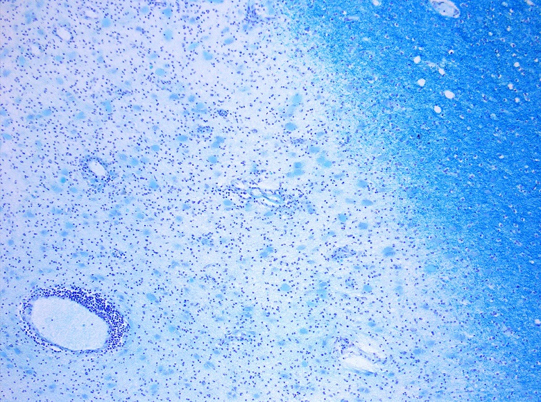 Bacteriile intestinale au un rol esenţial în declanşarea sclerozei multiple, arată un studiu realizat de cercetători elveţieni
