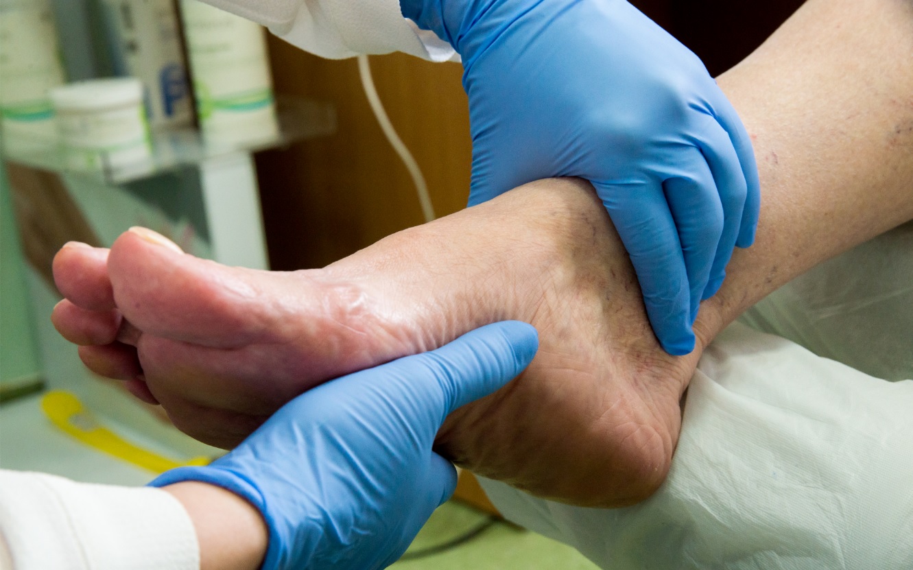 Asociaţia de Podiatrie: La fiecare 20 de secunde o persoană îşi pierde un picior din cauza diabetului în lume, deşi 8 din 10 amputaţii pot fi evitate