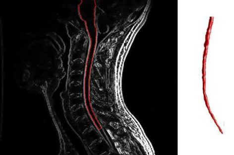 Scleroza multiplă creşte riscul de a dezvolta mai multe forme de cancer, arată un studiu realizat în Norvegia
