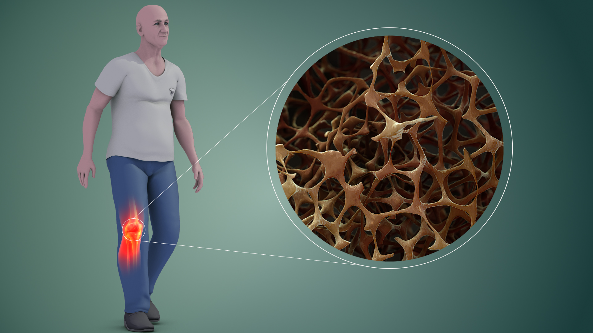 Stresul social reprezintă un factor favorizant al osteoporozei, arată un nou studiu american
