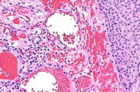 Pembrolizumab asociat cu axitinib ar putea deveni un nou standard în tratarea unui tip de cancer renal