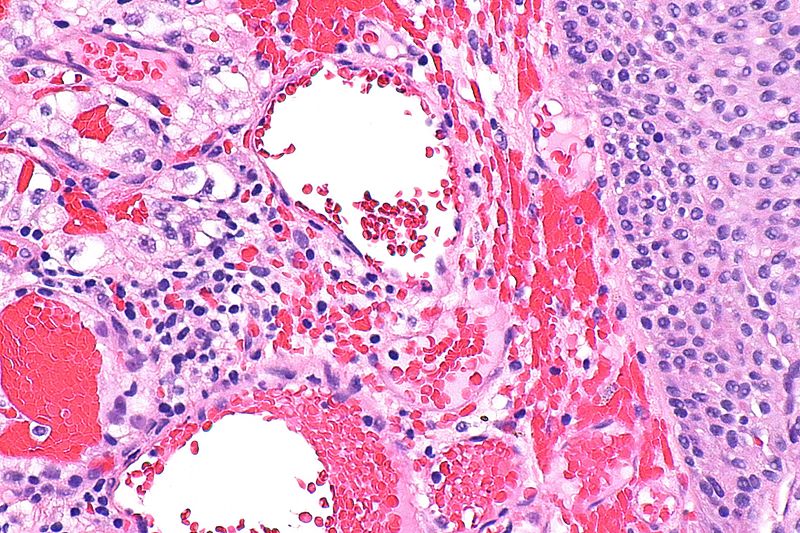 Pembrolizumab asociat cu axitinib ar putea deveni un nou standard în tratarea unui tip de cancer renal