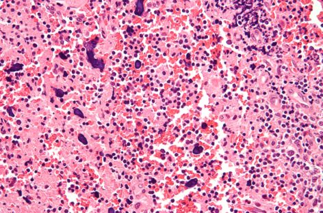 Dezechilibrul bacteriilor intestinale asociat cu lupusul eritrematos sistemic