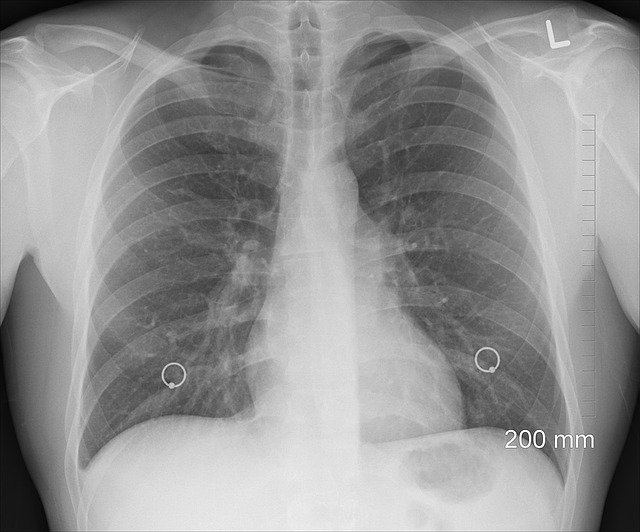 Cu noul coronavirus la CT. Cum arată un caz de pneumonie 2019-nCoV