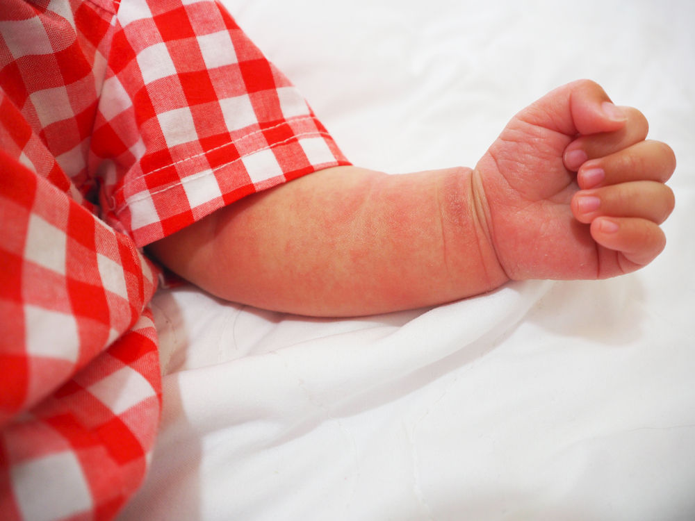 Tratament cu anticorpi monoclonali, „foarte eficient” în reducerea simptomelor dermatitei atopice la bebeluşi şi copiii mici