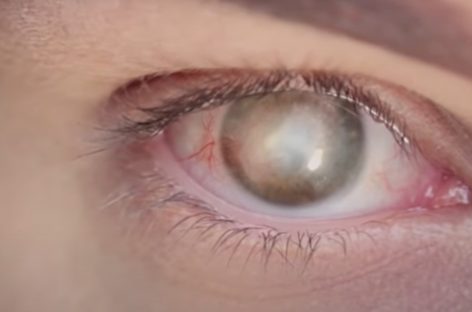 Premieră mondială în medicină: o persoană oarbă şi-a recăpătat vederea după un implant de cornee artificială