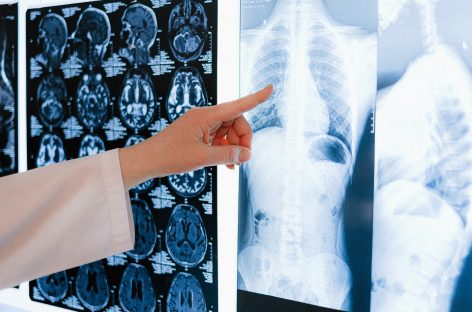 Potenţială ţintă terapeutică şi de diagnosticare pentru cancerul pulmonar