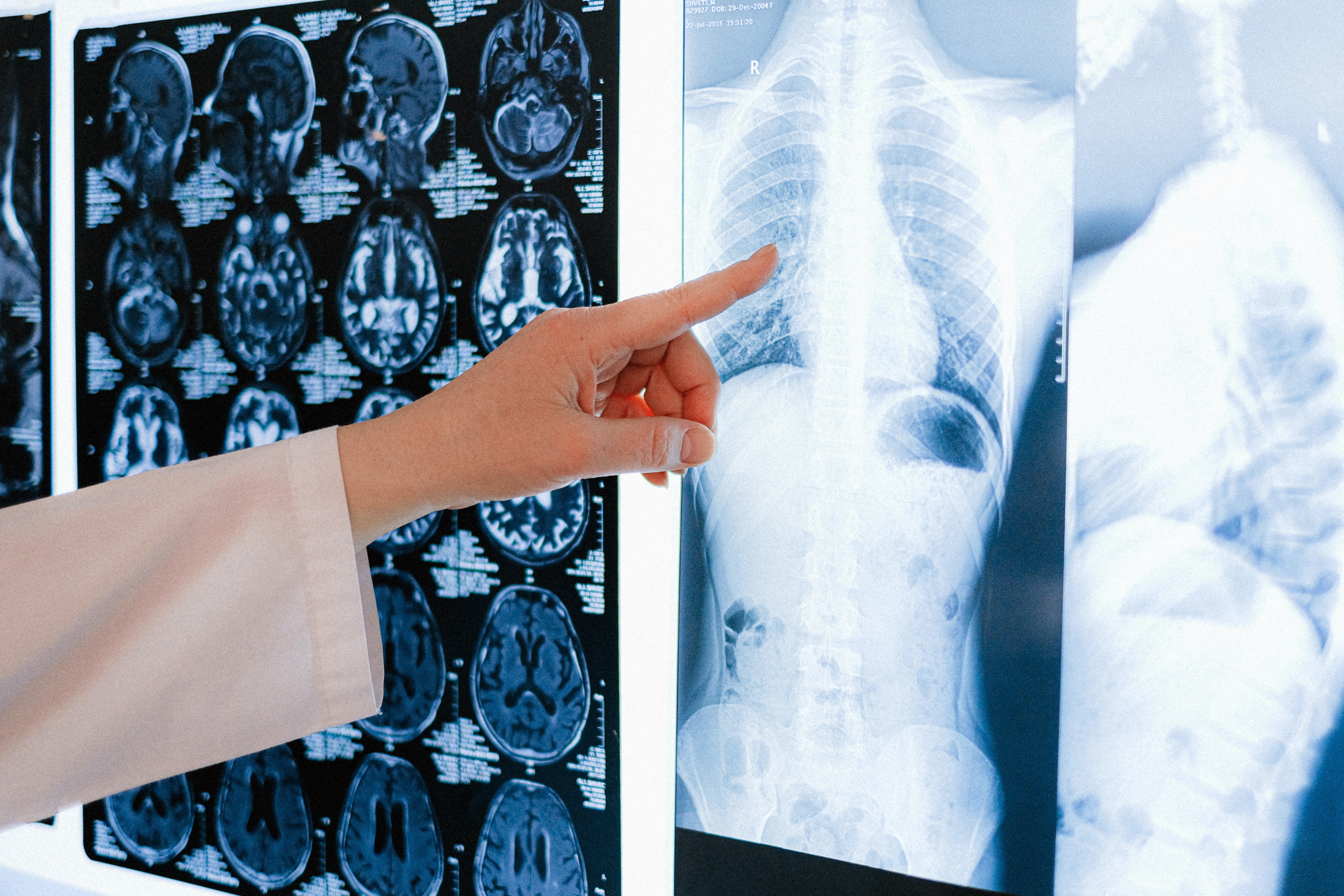 Potenţială ţintă terapeutică şi de diagnosticare pentru cancerul pulmonar