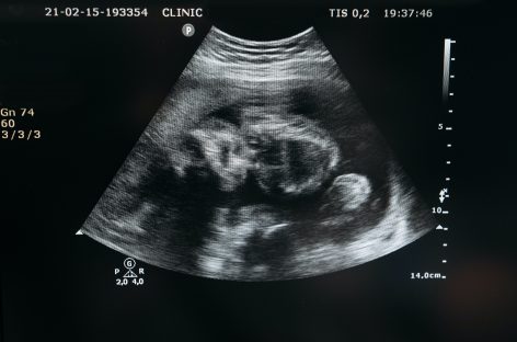 O genă care poate repara defectele cardiace congenitale, descoperită de oamenii de ştiinţă