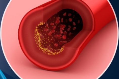 O nouă strategie pentru prevenirea înfundării arterelor, identificată de cercetători