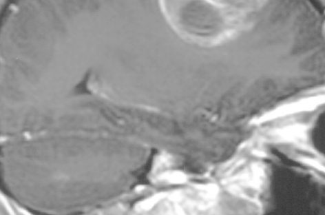 O abordare inovatoare pentru tratarea unor tumori cerebrale, descoperită de cercetători