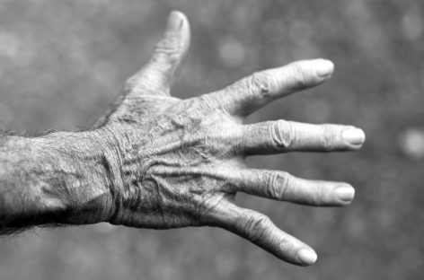 O variantă genetică comună identificată pentru sindromul de tunel carpian şi deget de declanşare