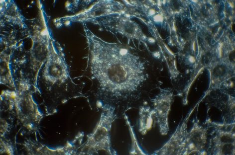 Vulnerabilitatea metabolică a neuroblastomului ar putea duce la noi terapii