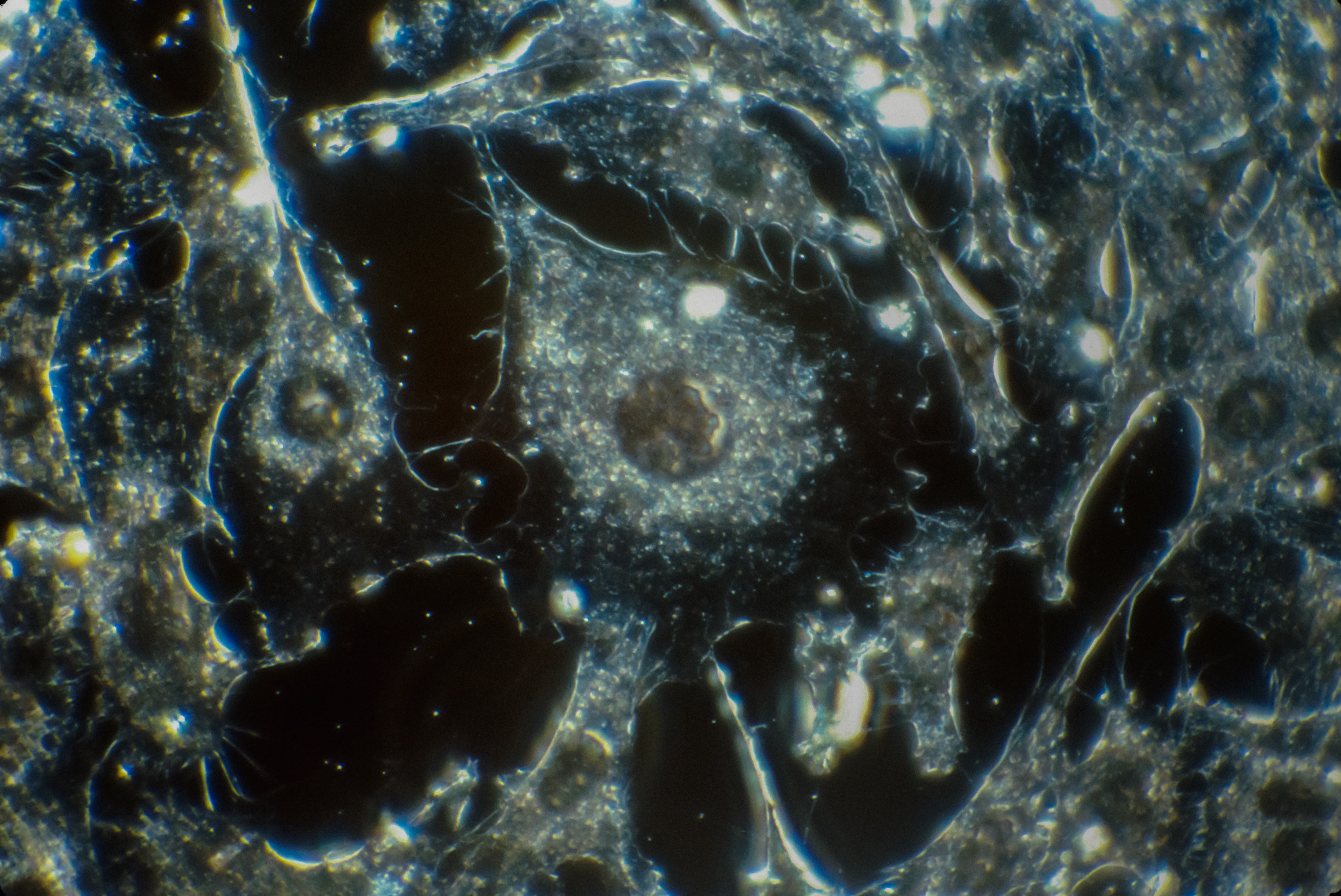 Vulnerabilitatea metabolică a neuroblastomului ar putea duce la noi terapii