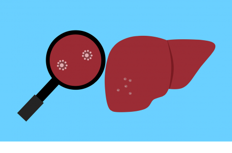 UPDATE privind inflamaţia hepatică acută de origine necunoscută la copii