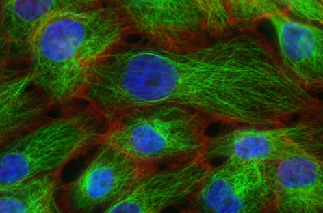 STUDIU: Anumite tipuri de cancer de sân pot fi încetinite prin identificarea precoce a unei mutaţii genetice