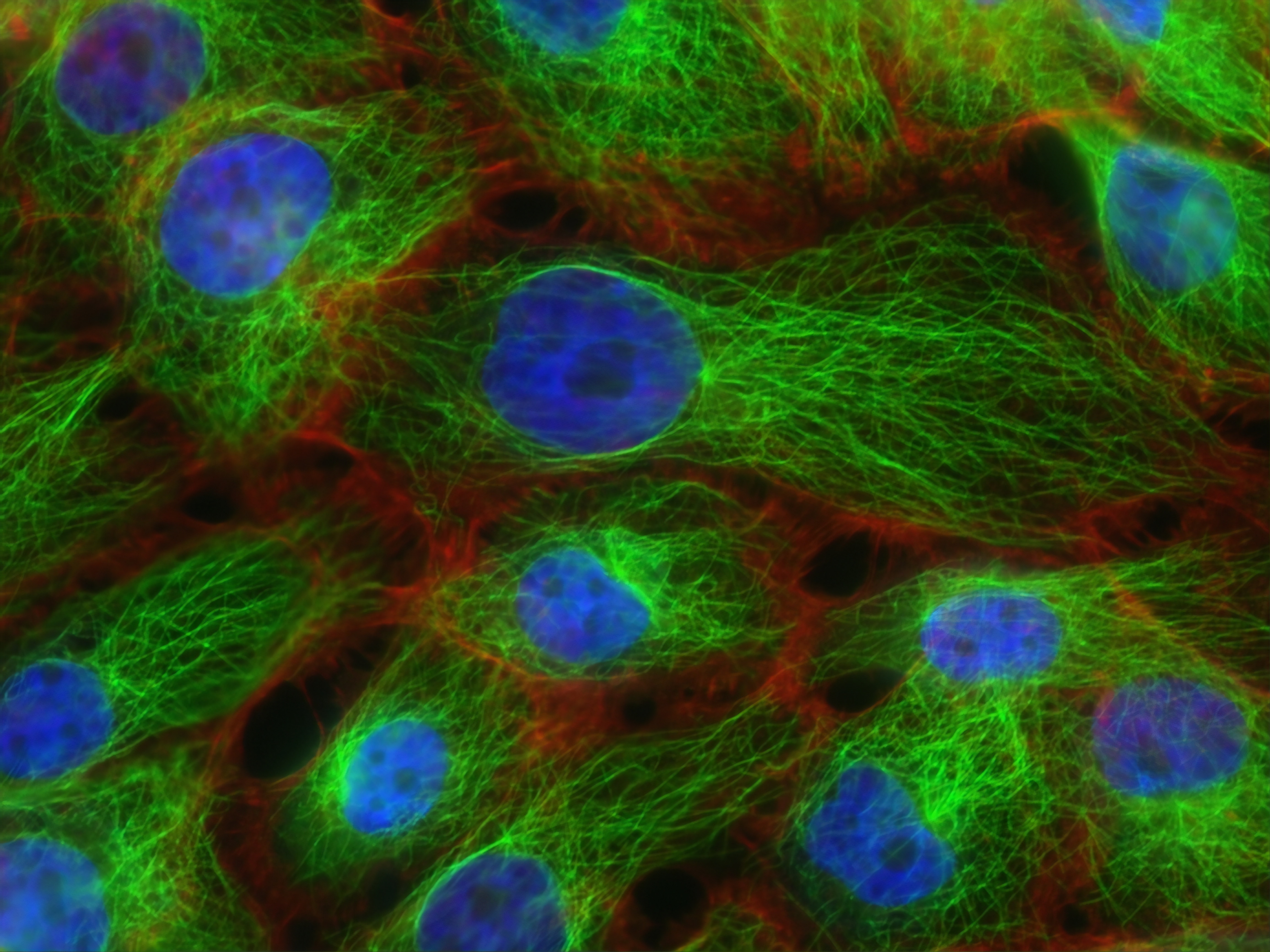 STUDIU: Anumite tipuri de cancer de sân pot fi încetinite prin identificarea precoce a unei mutaţii genetice