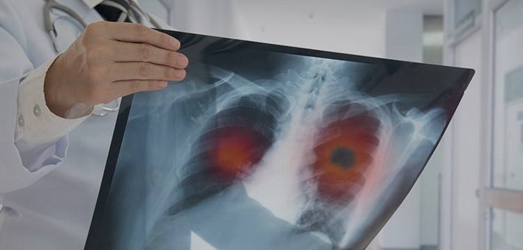 Ascultă-ţi tusea! Îndemnul profesioniştilor din domeniul sănătăţii pentru diagnosticarea precoce a cancerului bronho-pulmonar în România