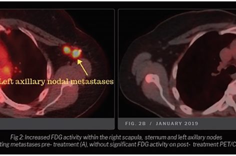Primele posibile explicaţii pentru un caz rar de remisie a bolii la o pacientă cu cancer mamar în stadiu IV metastazat