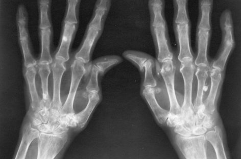 Procese moleculare cheie identificate în artrita reumatoidă