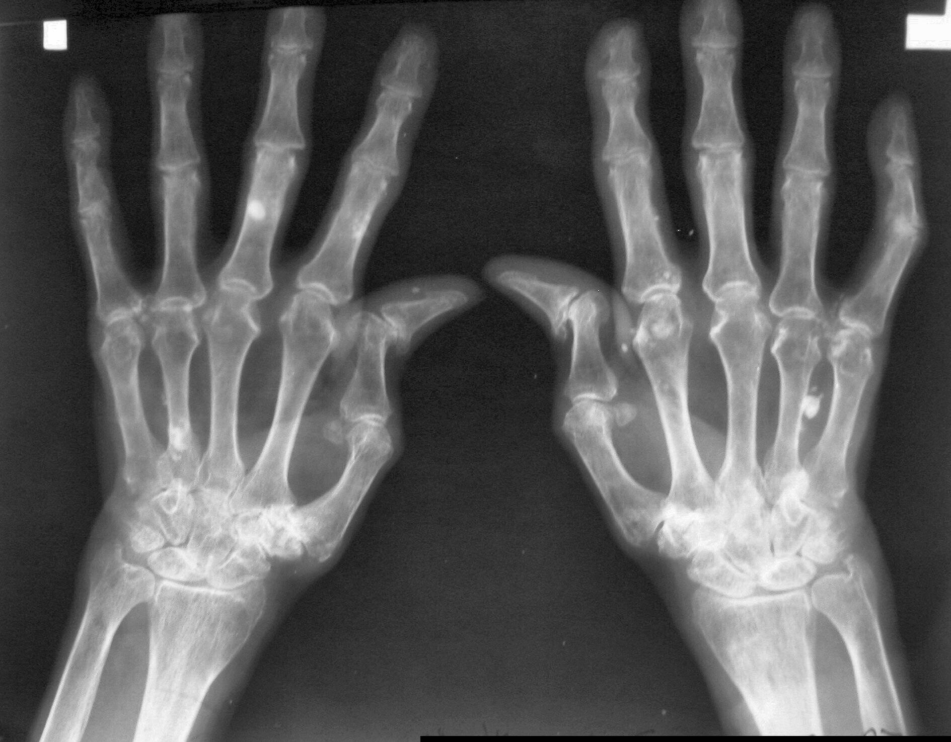 Procese moleculare cheie identificate în artrita reumatoidă