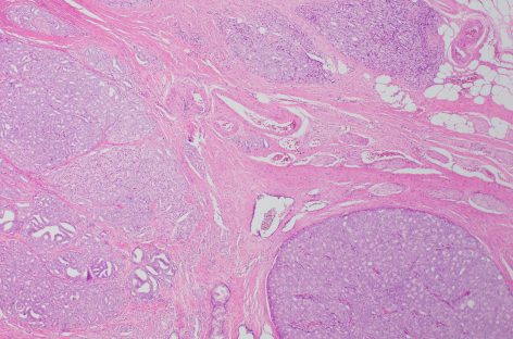 Noi markeri epigenetici pentru cancerul de prostată, descoperiţi de cercetători