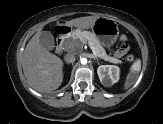 Eşecuri alarmante în depistarea cancerului pancreatic, semnalează specialiştii prezenţi la UEG Week 2022