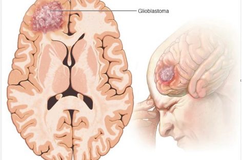 Posibilă ţintă pentru tratarea cancerului cerebral rezistent la tratament