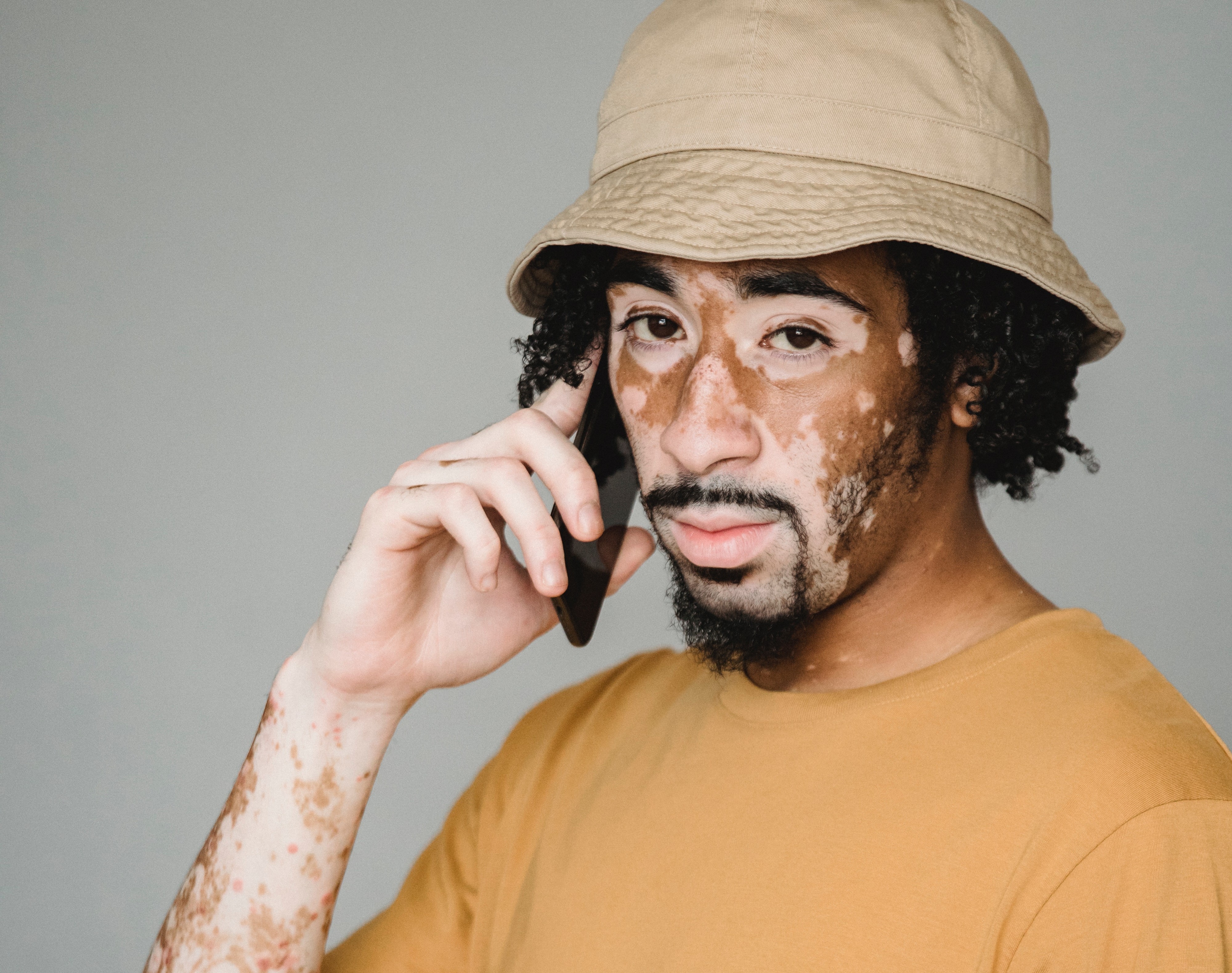 Primul tratament aprobat în SUA pentru vitiligo obţine rezultate eficiente în două studii clinice de fază III