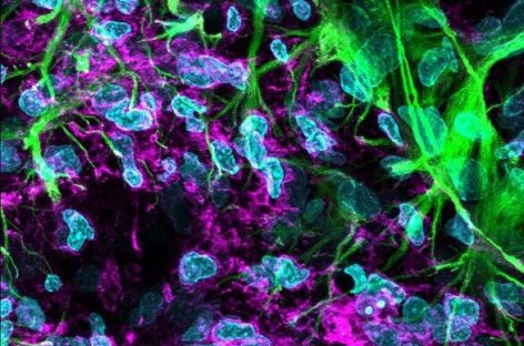 Medicamentul metoprolol are o acţiune neuroprotectoare după un AVC, au descoperit oamenii de ştiinţă