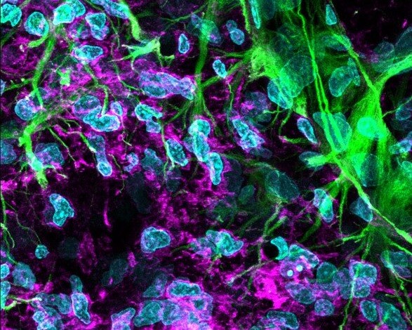Medicamentul metoprolol are o acţiune neuroprotectoare după un AVC, au descoperit oamenii de ştiinţă
