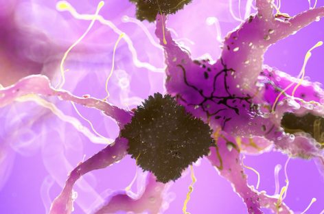Combinarea unui medicament experimental „promiţător" pentru Alzheimer cu unul pentru eliminarea cheagurilor, cauza hemoragiei cerebrale care a dus la decesul unui pacient în timpul testelor clinice