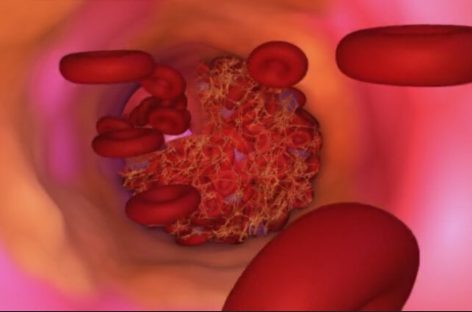 Astmul bronşic, asociat cu o acumulare crescută de plăci în arterele care duc la creier