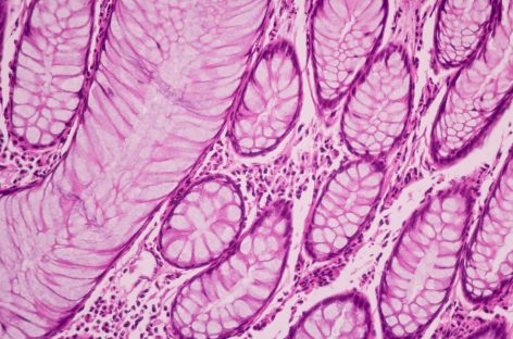 Cercetătorii au pus la punct un instrument cu care pot detecta riscul de progresie a pre-cancerului de sân