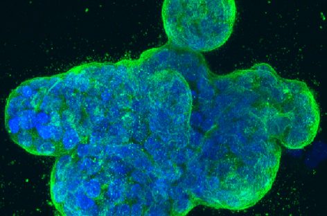 Celulele B ale sistemului imunitar ar putea estima răspunsul la tratament în cancerul de sân