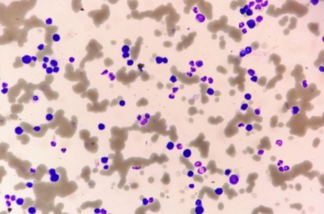 Primele teste clinice la om cu un nou medicament pentru cancerul de sânge recidivat furnizează rezultate promiţătoare