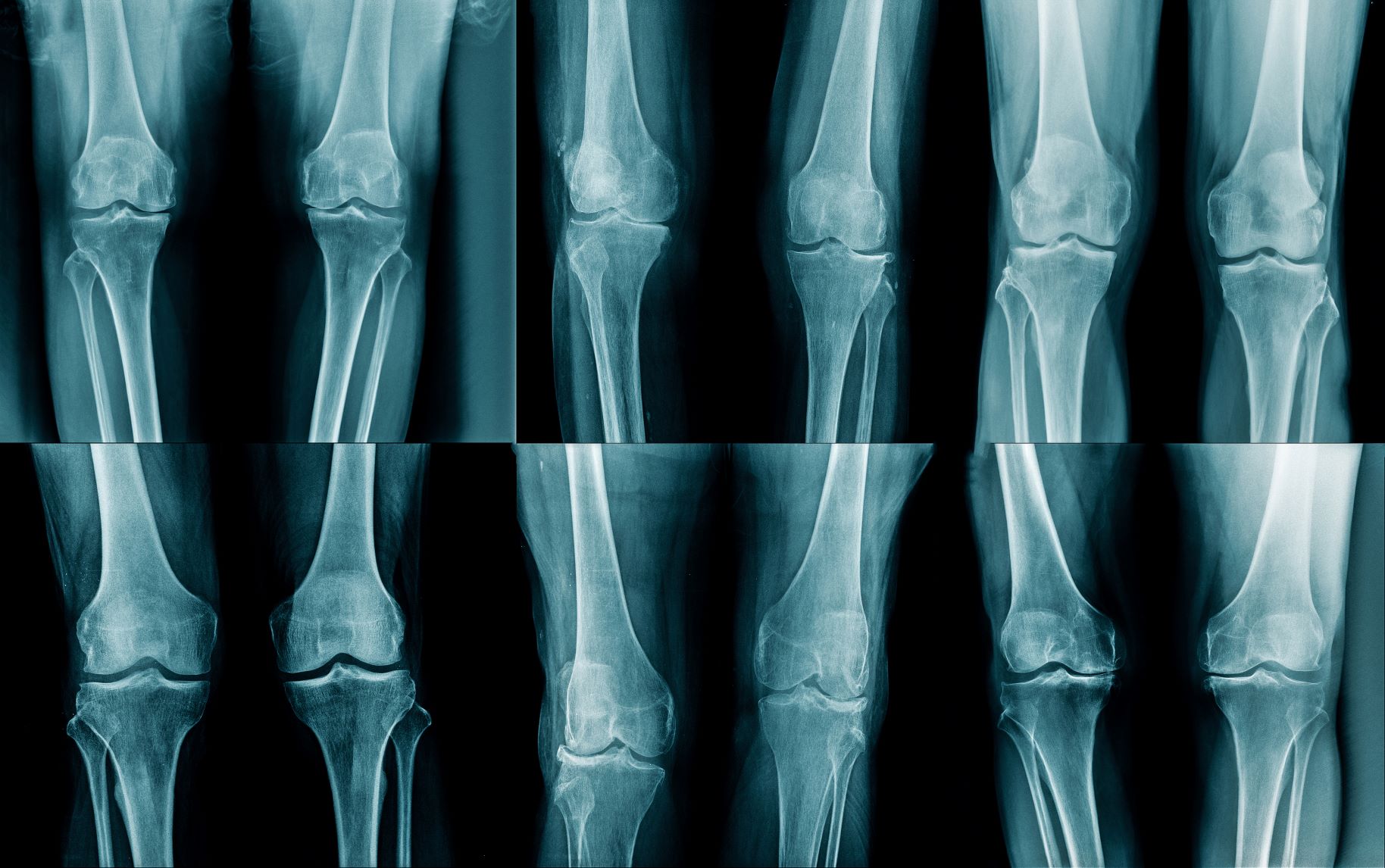 STUDIU: Analgezicele antiinflamatorii pot agrava artrita
