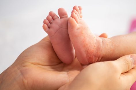UPDATE Primul deces din cauza rujeolei: un bebeluş de 7 luni. Ministerul Sănătăţii a declarat epidemie de rujeolă la nivel naţional pe 5 decembrie