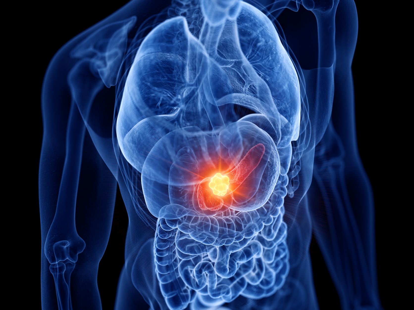 Noi abordări terapeutice pentru tratarea cancerului pancreatic metastatic