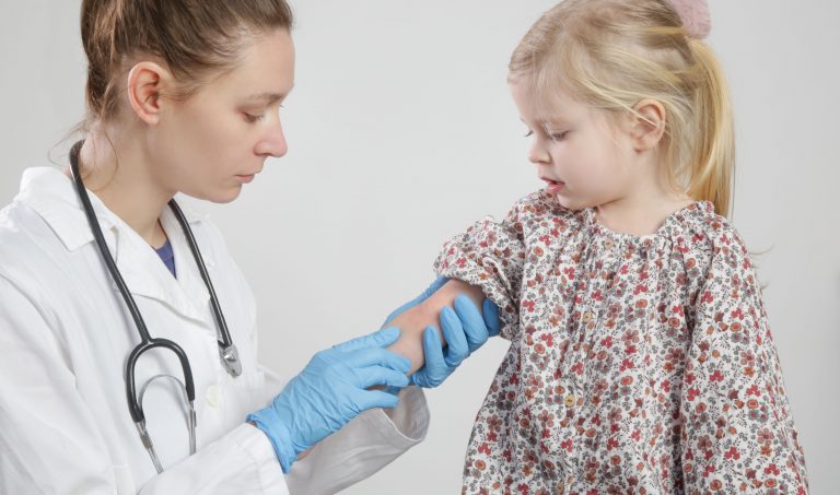 STUDIU: Dermatita atopică creşte riscul de fracturi la copii