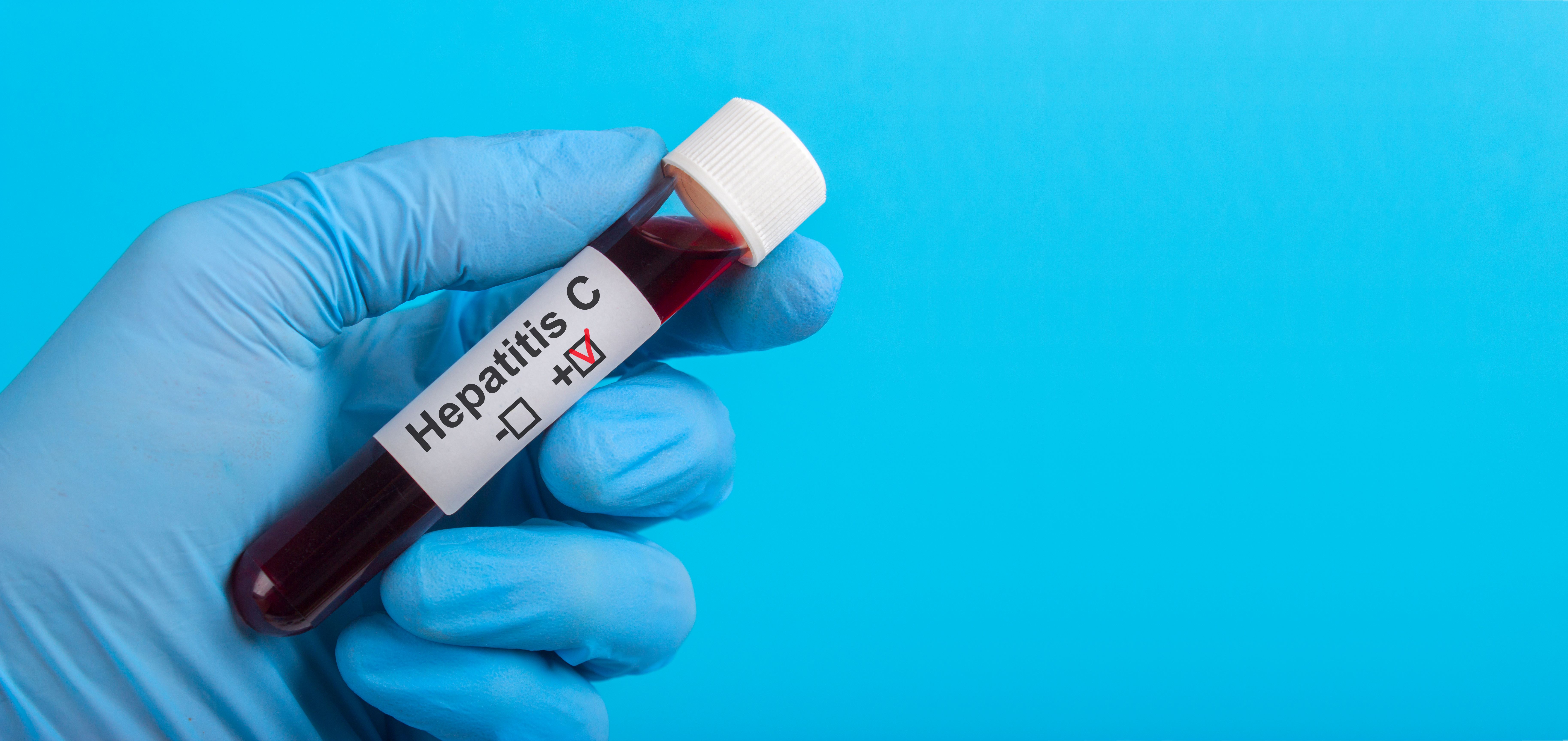 Noutăţi în programul de tratament fără interferon al hepatitei C