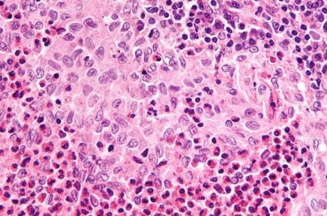 Originile unei boli grave la copii, asemănătoare cancerului, identificate de cercetători