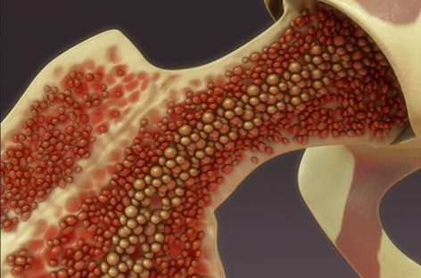 Tratament mai sigur pentru prevenirea unui efect secundar grav al transplantului de măduvă