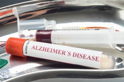 Noi markeri descoperiţi în sânge ar putea indica boala Alzheimer cu zece ani înainte de apariţia simptomelor